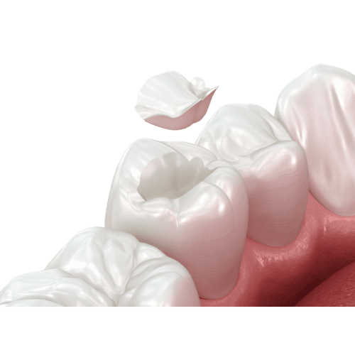 Inlays - Professioneller Zahnersatz vom Dentallabor Muharremi in Zürich