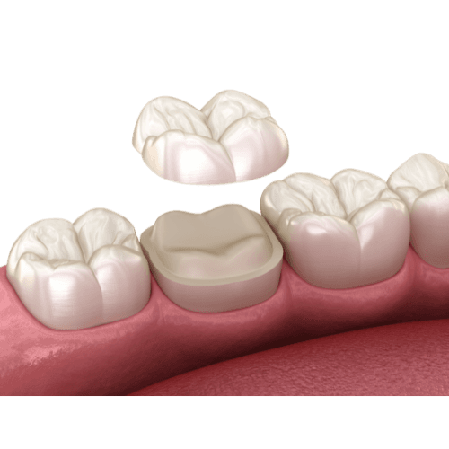 Onlays - Professioneller Zahnersatz vom Dentallabor Muharremi in Zürich