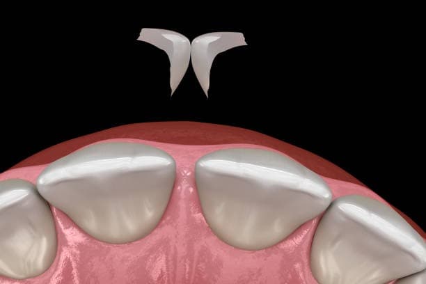 Non-Prep-Veneers - Professioneller Zahnersatz vom Dentallabor Muharremi in Zürich